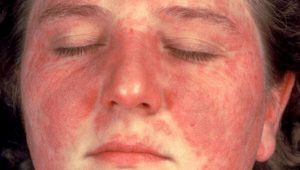 LUPUS ERYTHEMATOSUS contraindications In beauty therapy