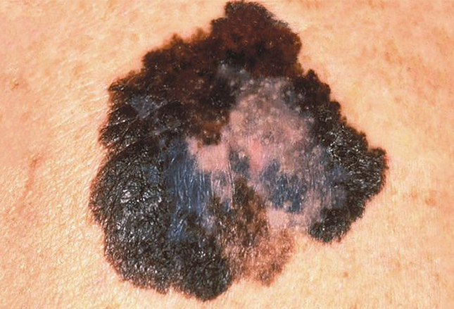 MELANOMA contraindications In beauty therapy