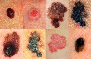 MOLE contraindications In beauty therapy