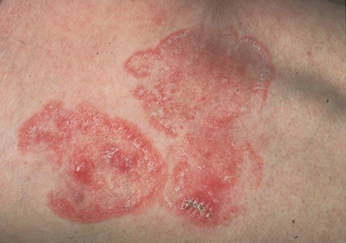 MYCOSIS FUNGOIDES contraindications In beauty therapy