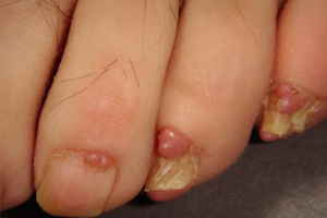 NAIL TUMOR contraindications In beauty therapy