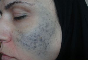 NEVUS OF OTA contraindications In beauty therapy