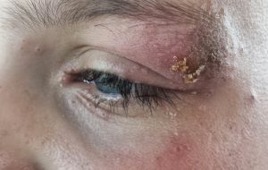 OCULAR HERPES contraindications In beauty therapy