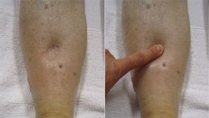 OEDEMA contraindications In beauty therapy