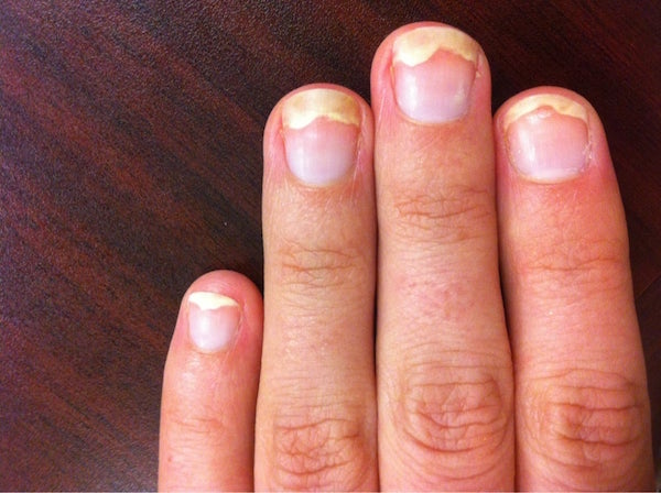 ONYCHOLYSIS (NAIL SEPARATION) contraindications In beauty therapy