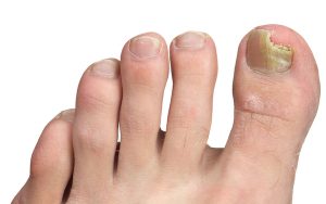ONYCHOMYCOSIS (TINEA UNGUIUM) contraindications In beauty therapy