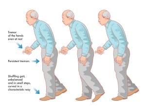 PARKINSON’S DISEASE contraindications In beauty therapy
