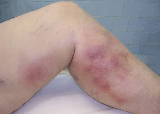 PHLEBITIS (SUPERFICIAL THROMBOPHLEBITIS) contraindications In beauty therapy