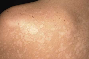 PITYRIASIS ALBA contraindications In beauty therapy