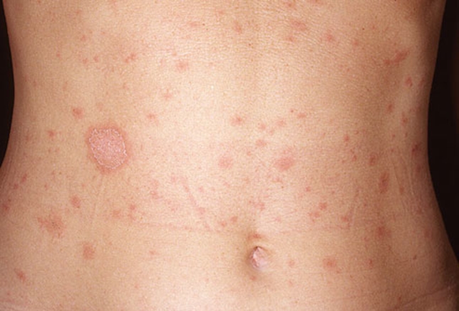 PITYRIASIS ROSEA contraindications In beauty therapy