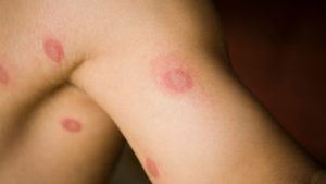 RINGWORM (Fungal infections) contraindications In beauty therapy