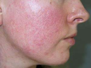 ROSACEA contraindications In beauty therapy