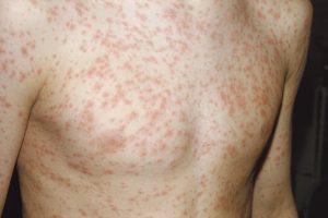 RUBELLA contraindications In beauty therapy