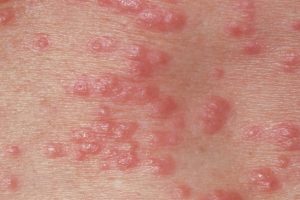 SCABIES contraindications In beauty therapy