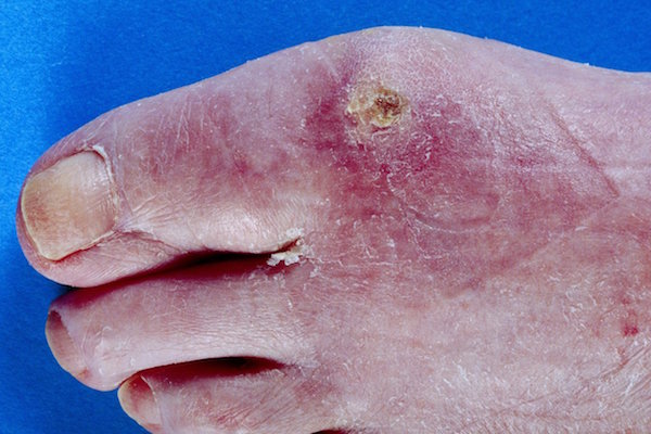 SCLERODERMA contraindications In beauty therapy
