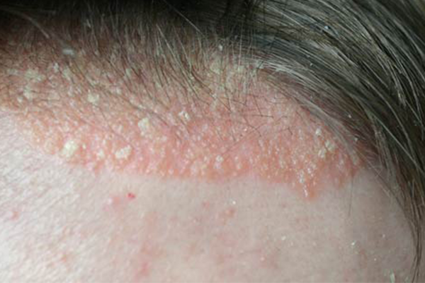 white scalp patches