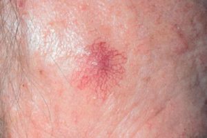 SPIDER ANGIOMA contraindications In beauty therapy