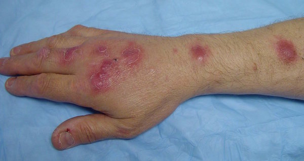 SPOROTRICHOSIS contraindications In beauty therapy