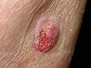 SQUAMOUS CELL CARCINOMA (SCC) contraindications In beauty therapy