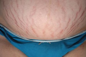 STRETCH MARKS (STRIAE) contraindications In beauty therapy