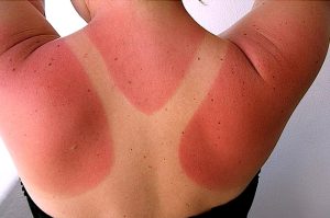 SUNBURN contraindications In beauty therapy
