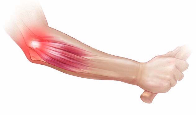 TENNIS ELBOW contraindications In beauty therapy