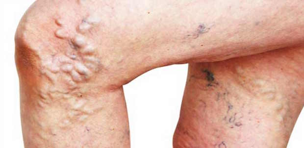 THROMBOSIS (DEEP VEIN THROMBOSIS, DVT) contraindications In beauty therapy