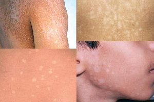 TINEA VERSICOLOR (PITYRIASIS VERSICOLOR) contraindications In beauty therapy
