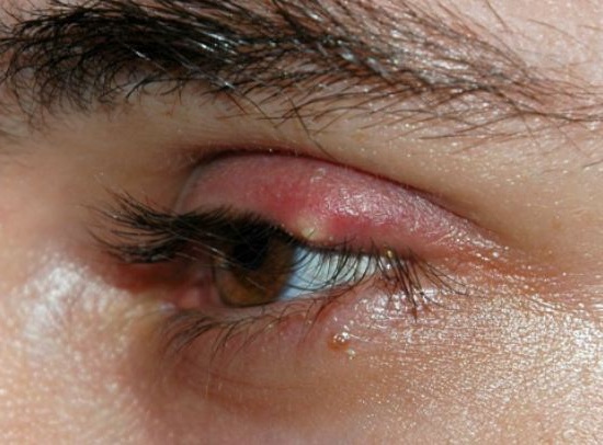 TRICHIASIS contraindications In beauty therapy