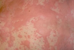 URTICARIA (HIVES) contraindications In beauty therapy