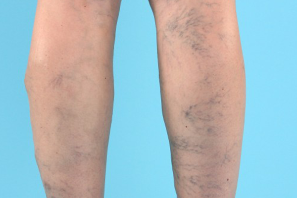 VARICOSE VEINS contraindications In beauty therapy