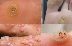 VERRUCAS AND WARTS contraindications In beauty therapy