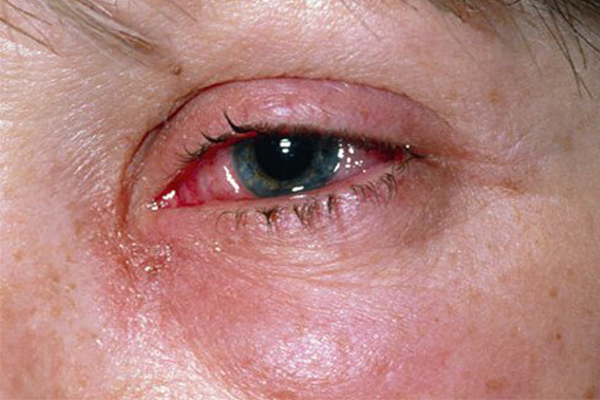 WATERY EYES (EPIPHORA) contraindications In beauty therapy