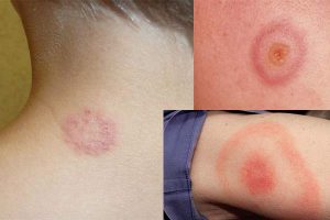 ERYTHEMA MULTIFORME contraindications In beauty therapy